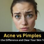 Acne vs Pimples